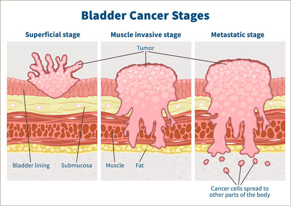 Stages of bladder cancer from Meyer et al., (2002). Bladder cancer can